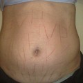Una brasileña aborta por un ataque neonazi en el que escriben sobre su piel con puñales
