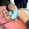Niño indio sobrevive después de que una barra de metal le atraviesa el tórax