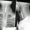 Le salvan la vida tras tragarse unas tijeras... como demuestra la radiografía