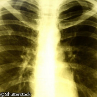 Científicos europeos desarrollan una prueba para diagnosticar la tuberculosis