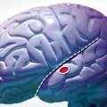 Los ciegos utilizan también la corteza visual del cerebro para oír