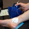 Estudiante del MIT desarrolla dispositivo barato de succión que acelera curación de heridas (ING)