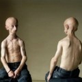 Enfermo de Progeria alcanza una edad inusual