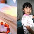 Cirujanos chinos salvan la mano de una niña implantándola en su pantorrilla