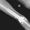 Italia: Fémur artificial fue implantado en un niño: La prótesis crecerá con él (IT)