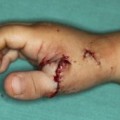 El dedo gordo del pie implantado en su mano devuelve la alegría a una niña