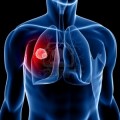 Científicos descifran el secreto del cáncer de pulmón bloqueando su regeneración
