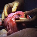El feto que agarró la mano del doctor que lo operaba