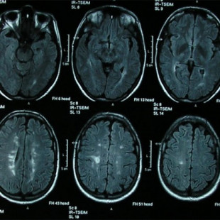 Científicos descubren cómo frenar la esclerosis múltiple
