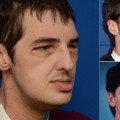 El transplante de cara más completo del mundo, 7 meses después [ENG]