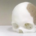 Sustituyen el 75% del cráneo de un paciente con un implante hecho con impresoras 3D [ENG]