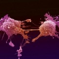 Investigadores españoles desarrollan terapia experimental que reduce en un 90 % la metástasis de melanoma en el pulmón