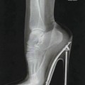 Radiografía del pie de una mujer con tacón alto