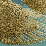 Avance contra el cáncer: una molécula hace que las células cancerosas 'exploten'