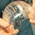 Sustituyen el cráneo de una mujer por uno de plástico impreso en 3D