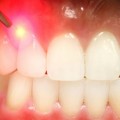 Consiguen regenerar dientes usando láser, adiós a los empastes