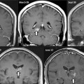 Resonancia magnética revela una solitaria en el cerebro de un hombre [EN]