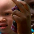 Albinos en Tanzania: "Nos están matando como animales"