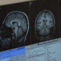 España realiza con éxito la primera operación de cerebro sin abrir el cráneo