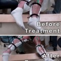Lesionados medulares vuelven a mover sus piernas sin necesidad de cirugía
