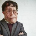 "Me han llamado mutante deforme": el drama de vivir con una desfiguración facial