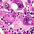 Cómo 'apagar' el cáncer: científicos convierten células cancerígenas en normales