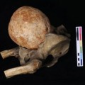 Desenterrado útero calcificado de más de 3 kilos en un cementerio Inglés