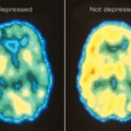 La depresión no es una elección: es un tipo de daño cerebral (ENG)