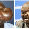 El doctor Cavadas extirpa un tumor gigante en la base del cráneo a un hombre de Kenia