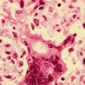 Una epidemia de sarampión en Rumanía deja 17 muertos y miles de enfermos