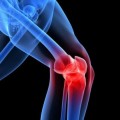 Científicos Chilenos obtienen resultados exitosos en Terapia Celular para tratar artrosis de rodilla