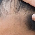 Avance en la investigación contra la calvicie: las células inmunitarias de la piel estimulan el crecimiento del pelo [E]