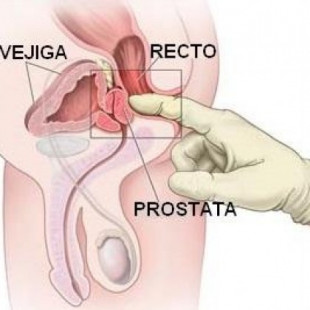 Cómo hacerse un autoexamen de próstata