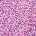 Científicos australianos evitan que el melanoma se propague a otros órganos