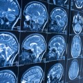 La inteligencia artificial es capaz de detectar Alzheimer diez años antes de los primeros síntomas