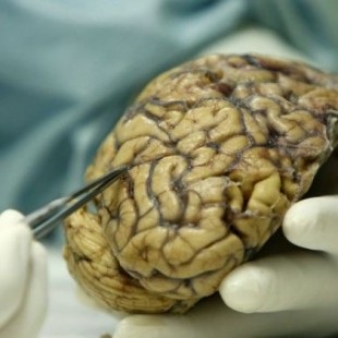 Científicos españoles frenan el crecimiento del tumor cerebral más común