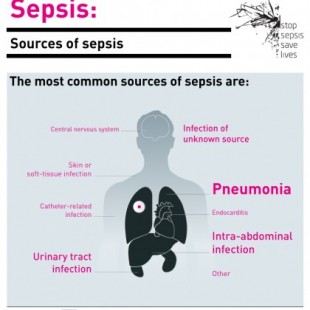 La sepsis, una enfermedad frecuente que mata