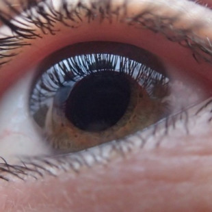 Unas 25.000 personas diagnosticadas de glaucoma podrían sufrir ceguera total