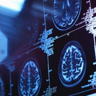 Un estudio detecta por primera vez cambios cerebrales en personas sanas con riesgo de sufrir Alzhéimer