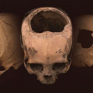 El arte de abrir cráneos: neurocirugía y trepanaciones durante el imperio inca