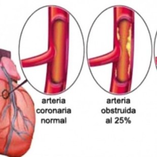 Lo que se debe saber del infarto agudo de miocardio