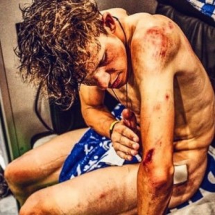 Bob Jungels publica una foto que muestra los efectos del pavés en el cuerpo de un ciclista