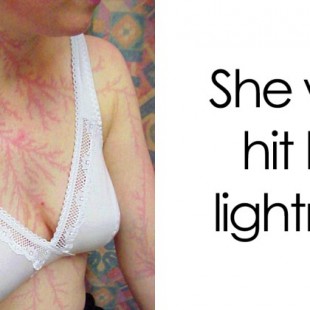 Cicatrices de personas que han sobrevivido al impacto de un rayo [ENG]
