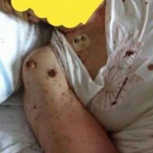 Encuentran a una paciente cubierta por hormigas en un hospital de Nápoles