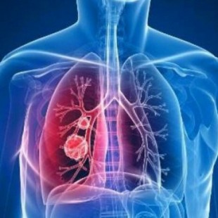 Golpe español al cáncer de pulmón: prometedora terapia sin efectos adversos