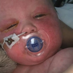 Brote de sarampión: Fotos de bebé hospitalizado muestran sus efectos devastadores [ENG]