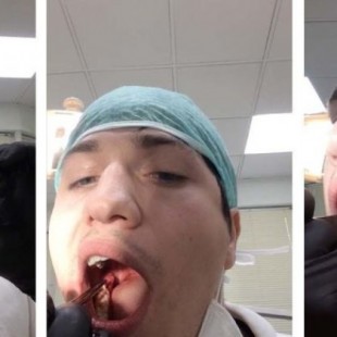 Un dentista ruso se extrae a sí mismo la muela del juicio