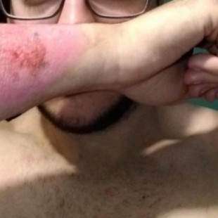 Usó un rallador de queso para quitarse un tatuaje del brazo y lo consiguió