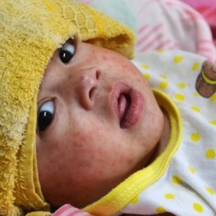 Argentina: Una mujer antivacunas contagia de sarampión a sus cinco hijos