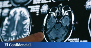 Una mutación 'blinda' el cerebro frente al alzhéimer y abre el camino a su tratamiento